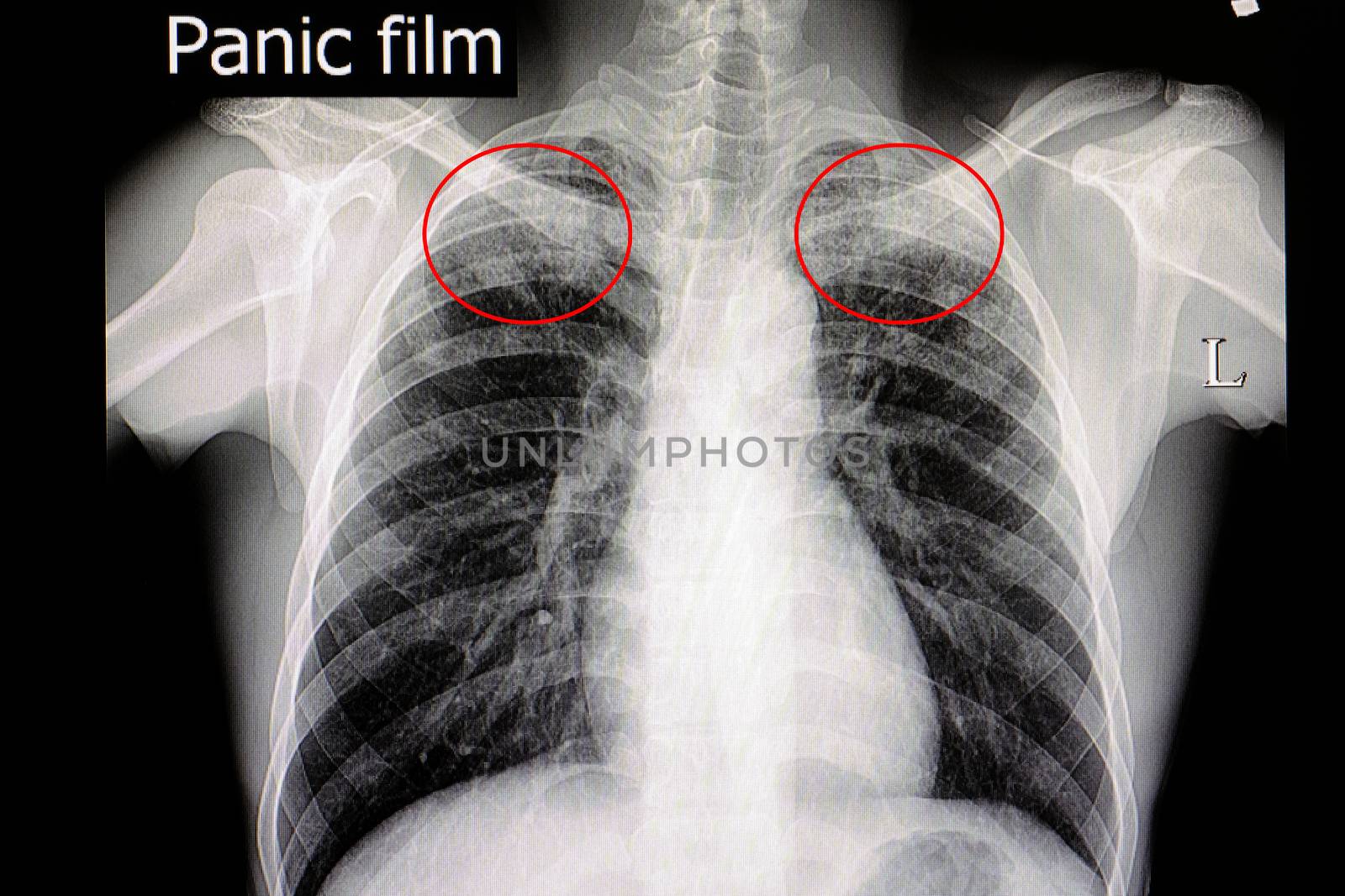 Xray film of a pateint with pulmonary tuberculosis