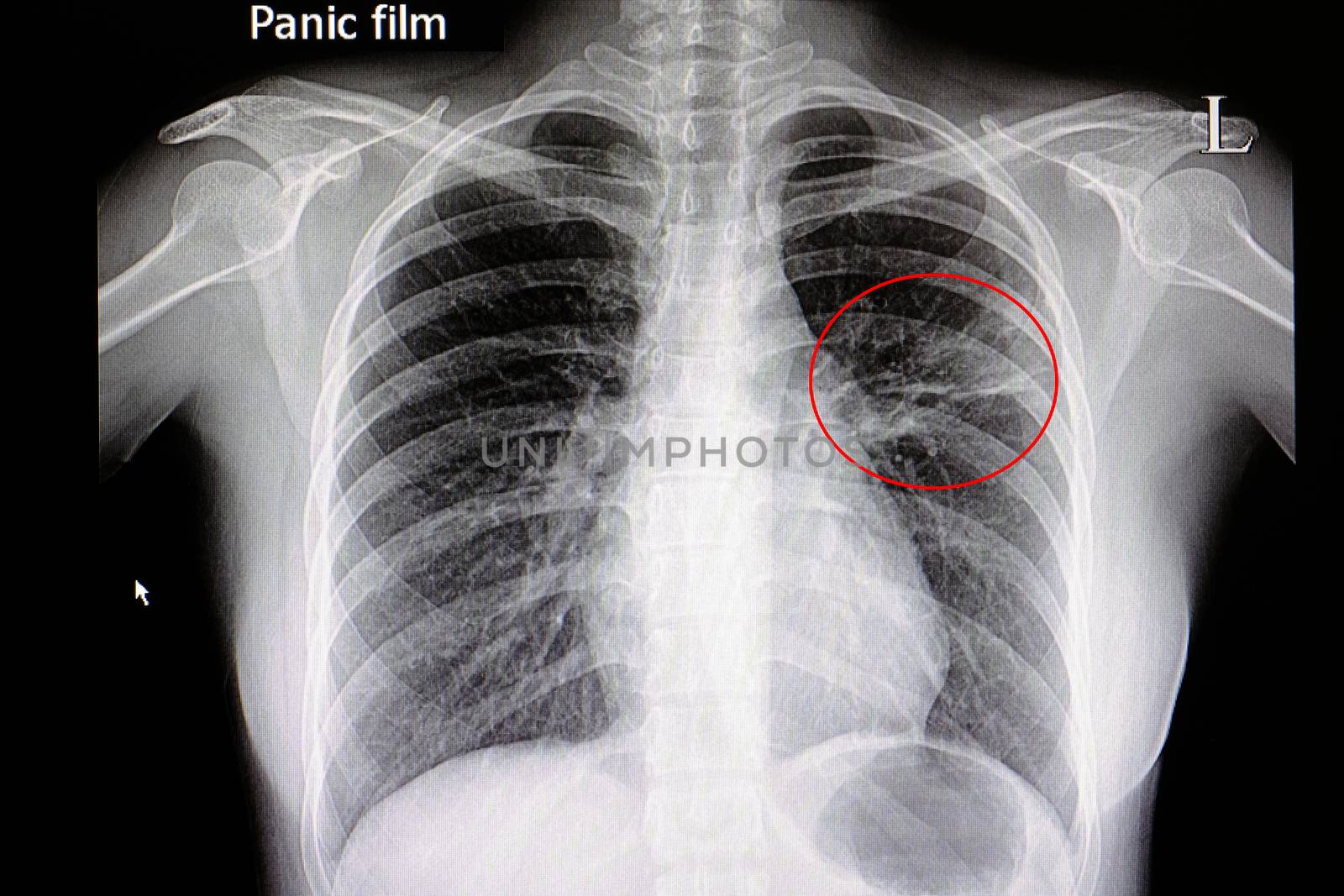 Xray film of a patient with pneumonia in his left middle lung