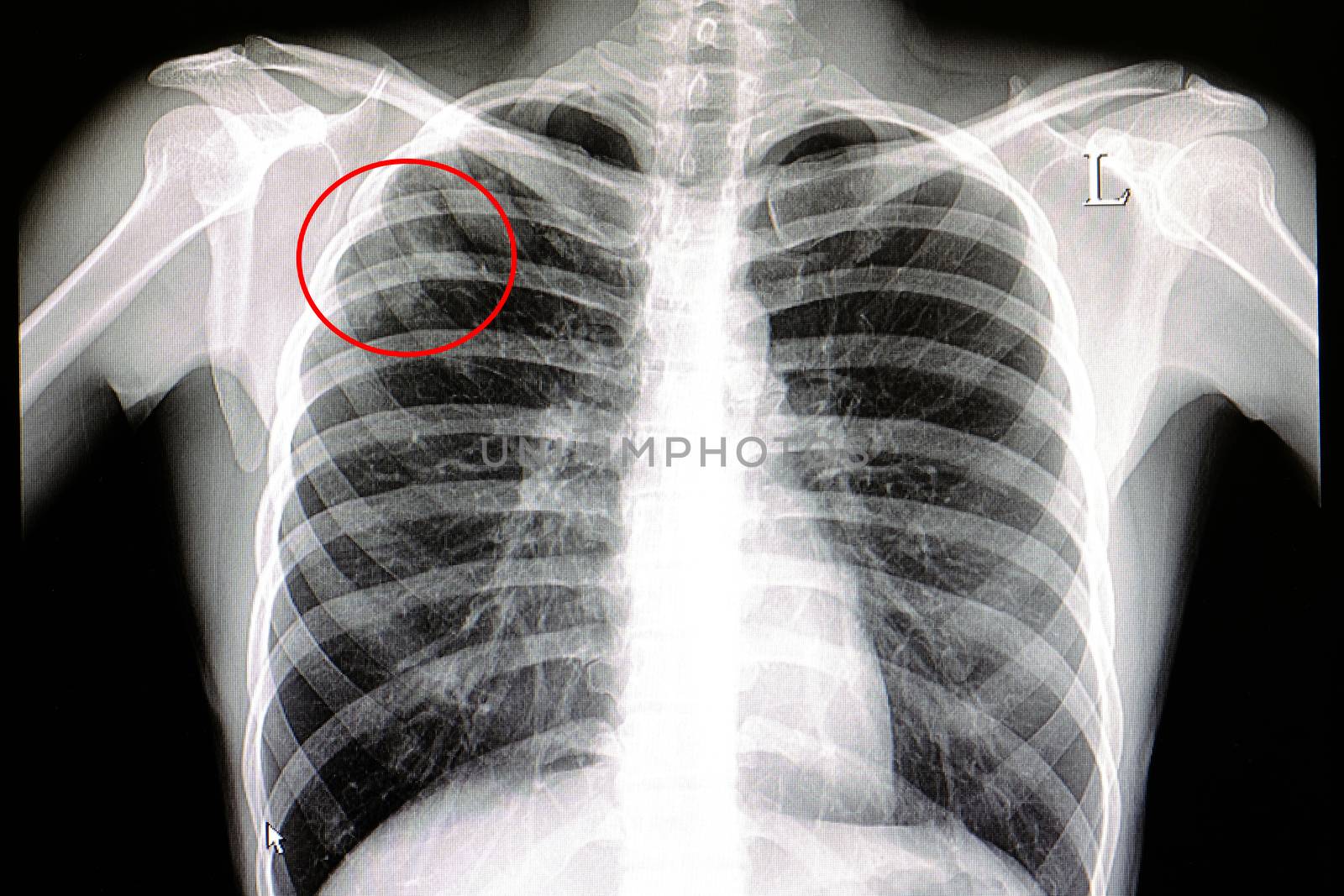 a chest x-ray film of a male patient showing rt upper lobe pulmonary tuberculosis