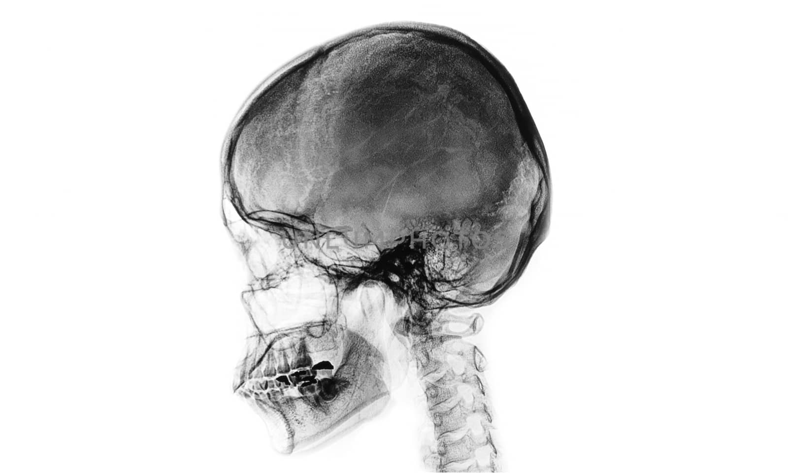A reversed contrast skull film of a patient in black and white.