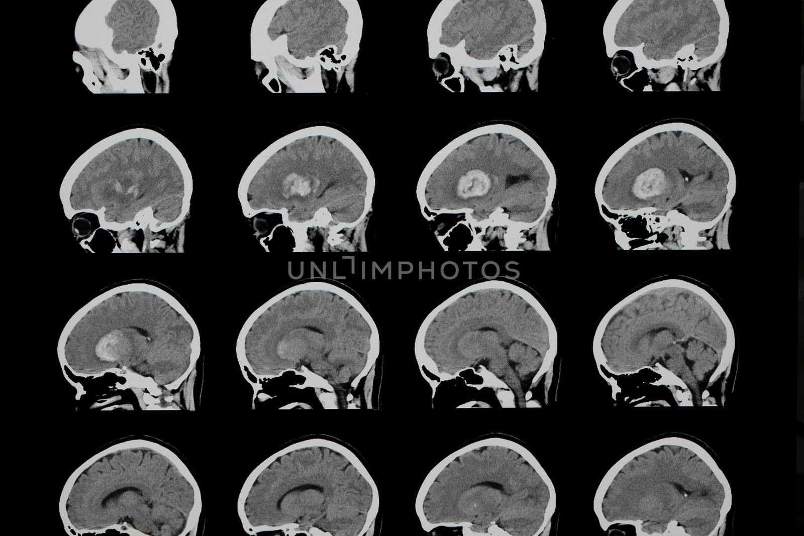 Brain computer tomography (CT) scan of a patient with large intracranial hemorrhage (hemorrhagic stroke) in his left cerebral hemisphere