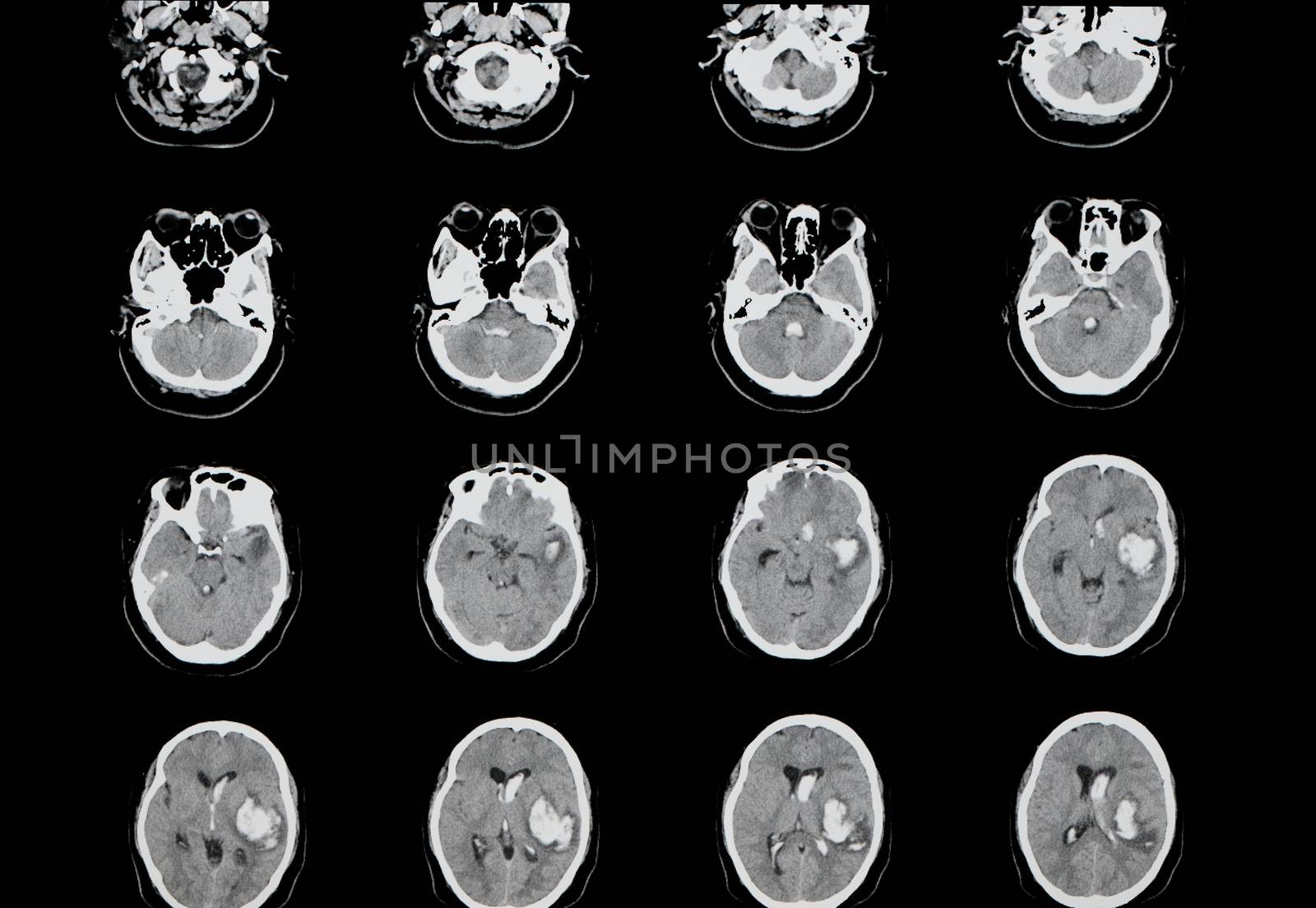 Brain computer tomography (CT) scan of a patient with large intracranial hemorrhage (hemorrhagic stroke) in his left cerebral hemisphere