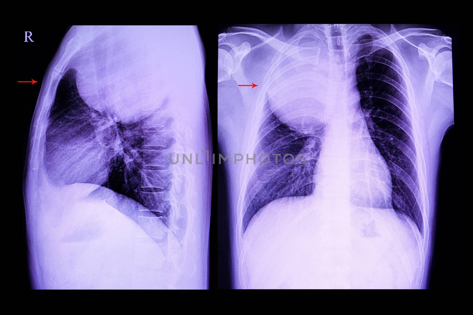 A chest xray film of a patient with a large circular mass in the right upper lung. Both antero-posterior and lateral chest xray films showing the position of the mass.