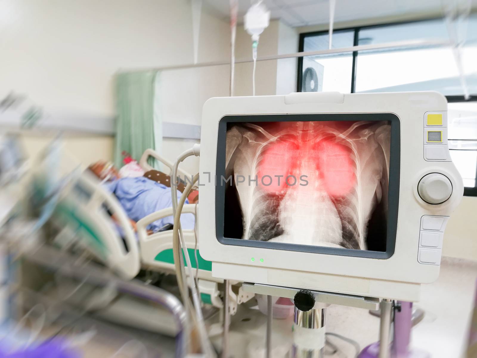 Human coronavirus lung Inflammation and infection show on screen in hospital patients