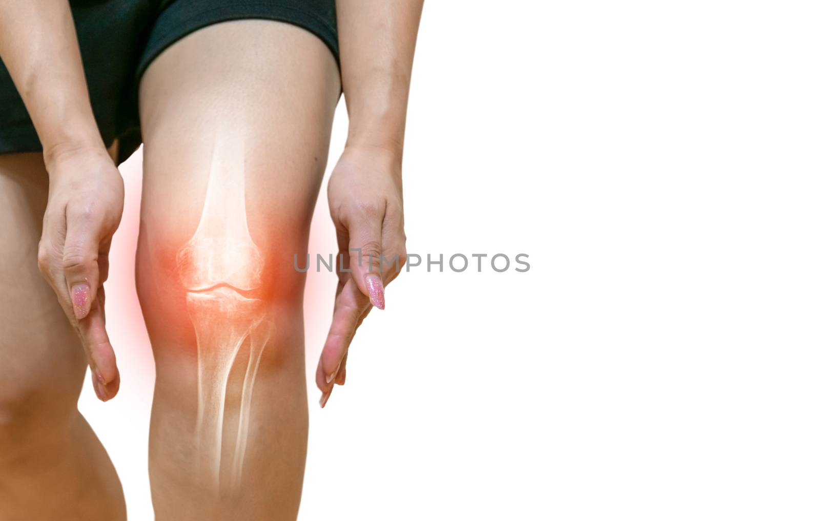 Human leg Osteoarthritis inflammation Of bone joints by sompongtom