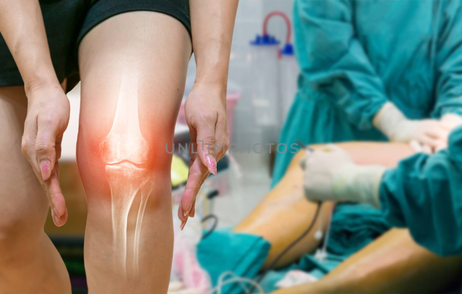 Human leg Osteoarthritis inflammation Of bone joints by sompongtom