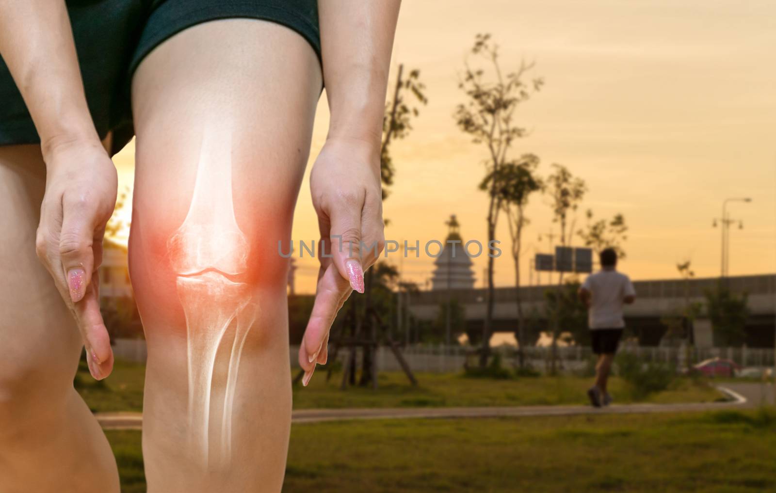 Human leg Osteoarthritis inflammation Of bone joints by sompongtom