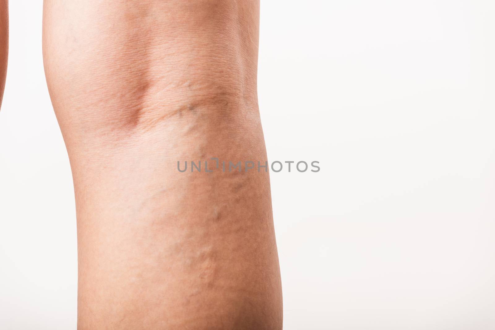 Woman painful varicose and spider veins on leg by Sorapop