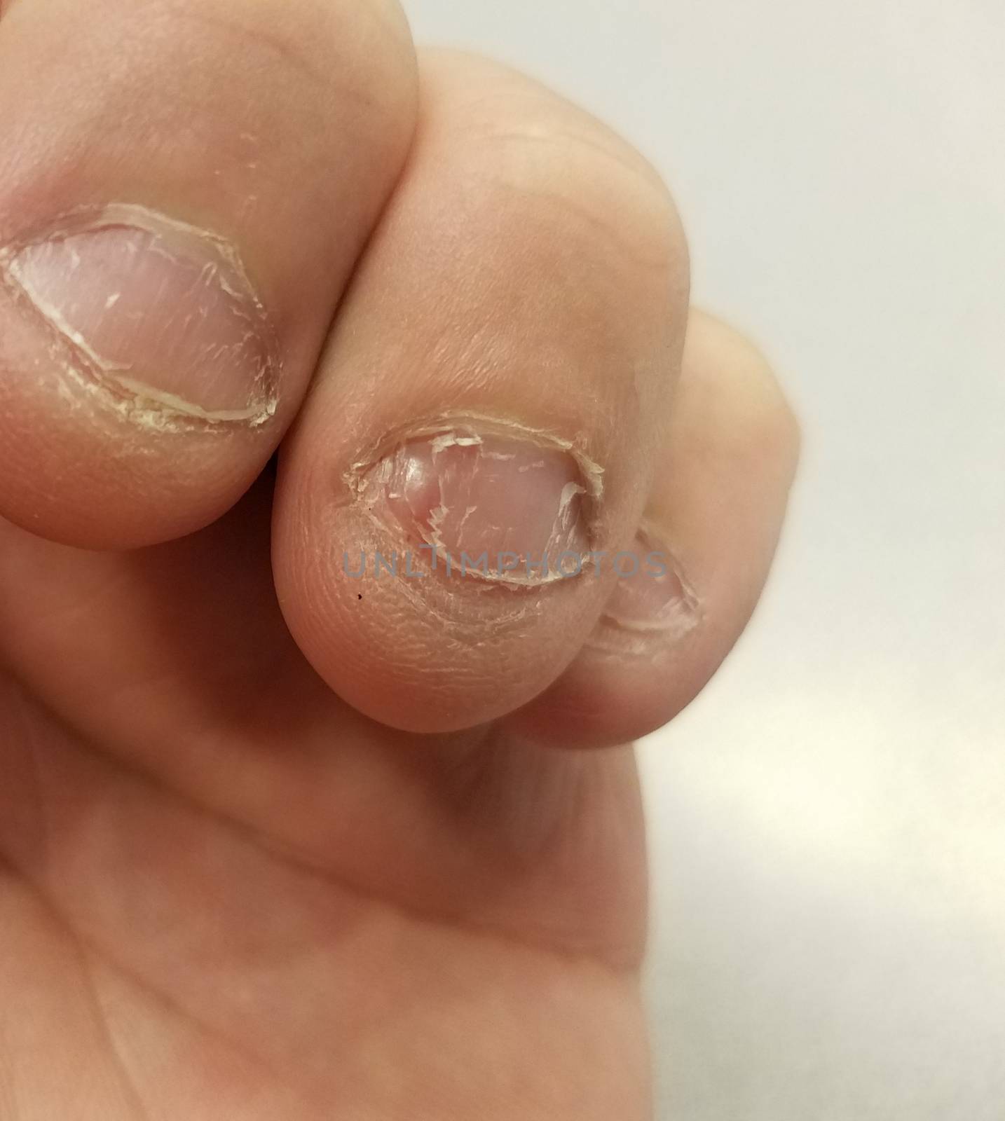 disgusting and gross bitten fingernail and fingers on hand