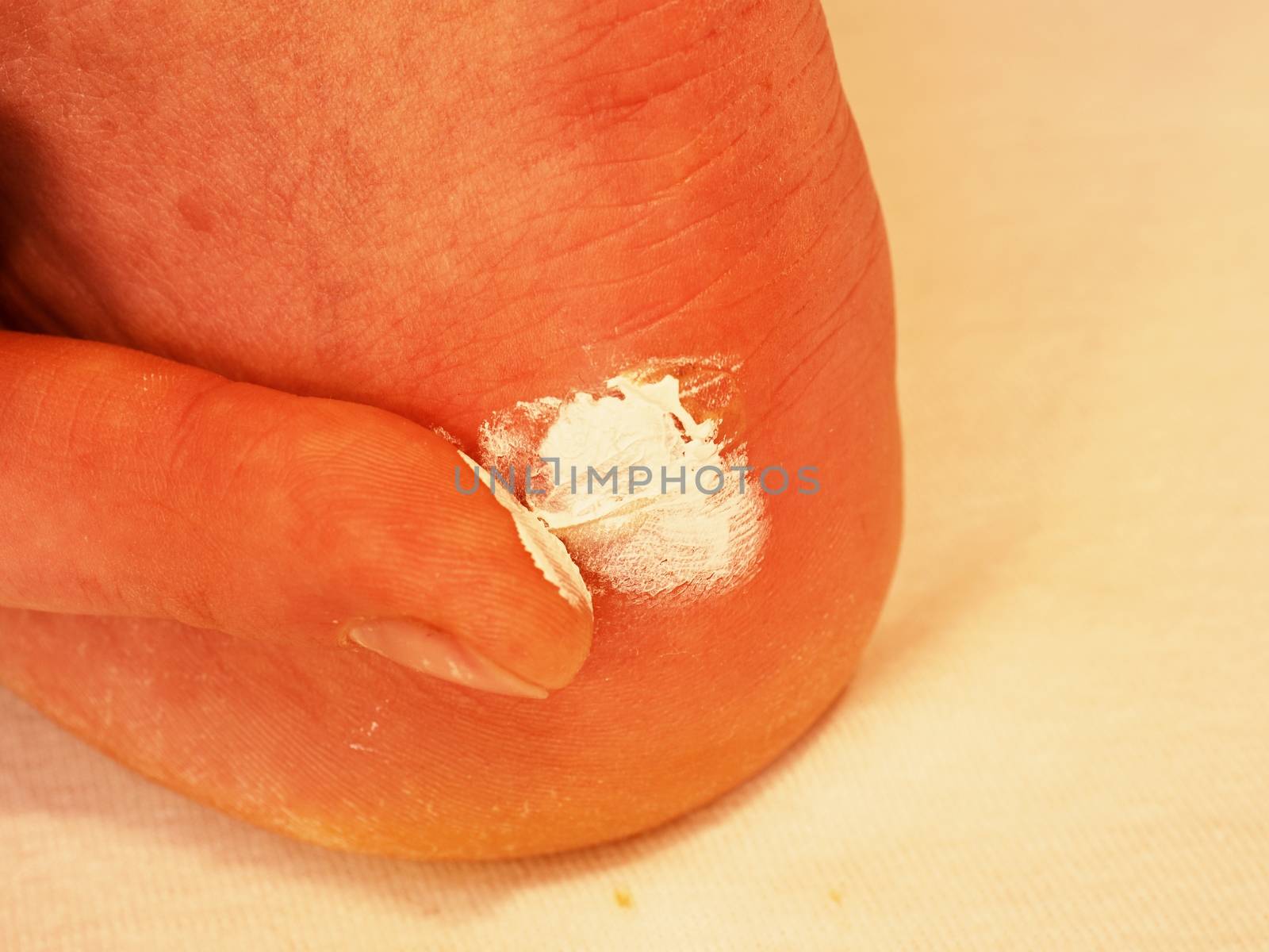 Hand drying and cleaning cracked bloody blister on heel. A painful place with torn skin, bloody and wetted wound with skin tresses. The clean wound is treated with a white healing ointment