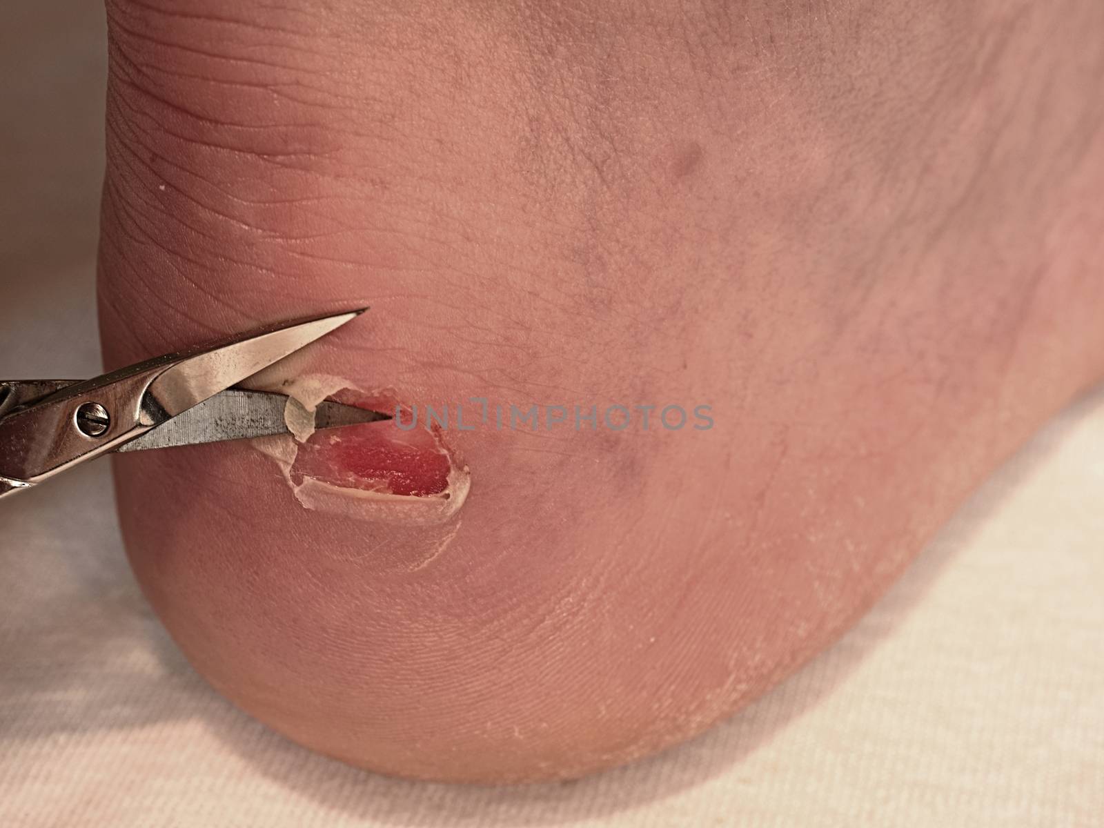 Small bended scissors cut skin at  cracked blister on man heel. Painful place with torn skin, by rdonar2