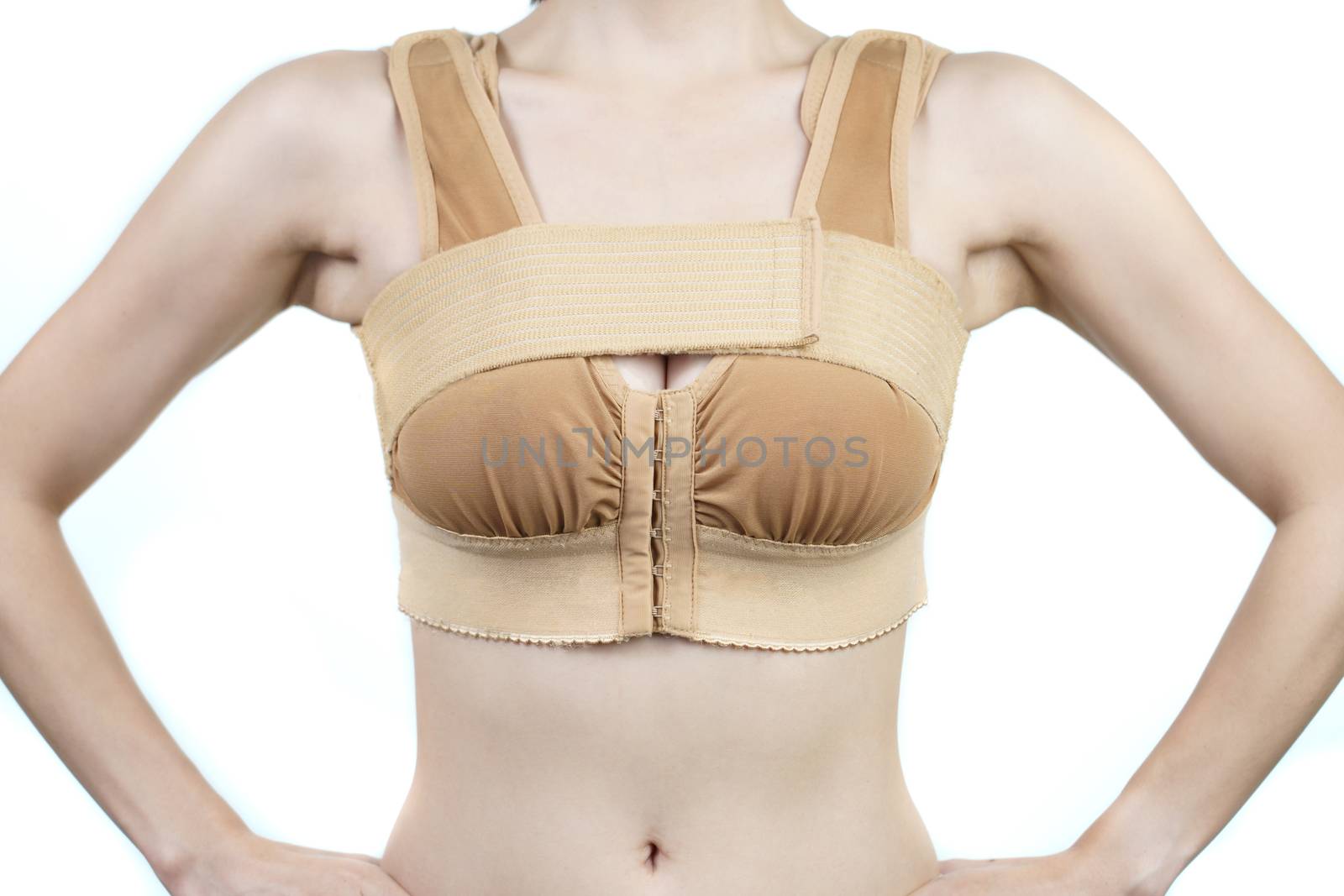 Woman posing in support bra after breast augmentation plastic surgery with silicone breast implants.