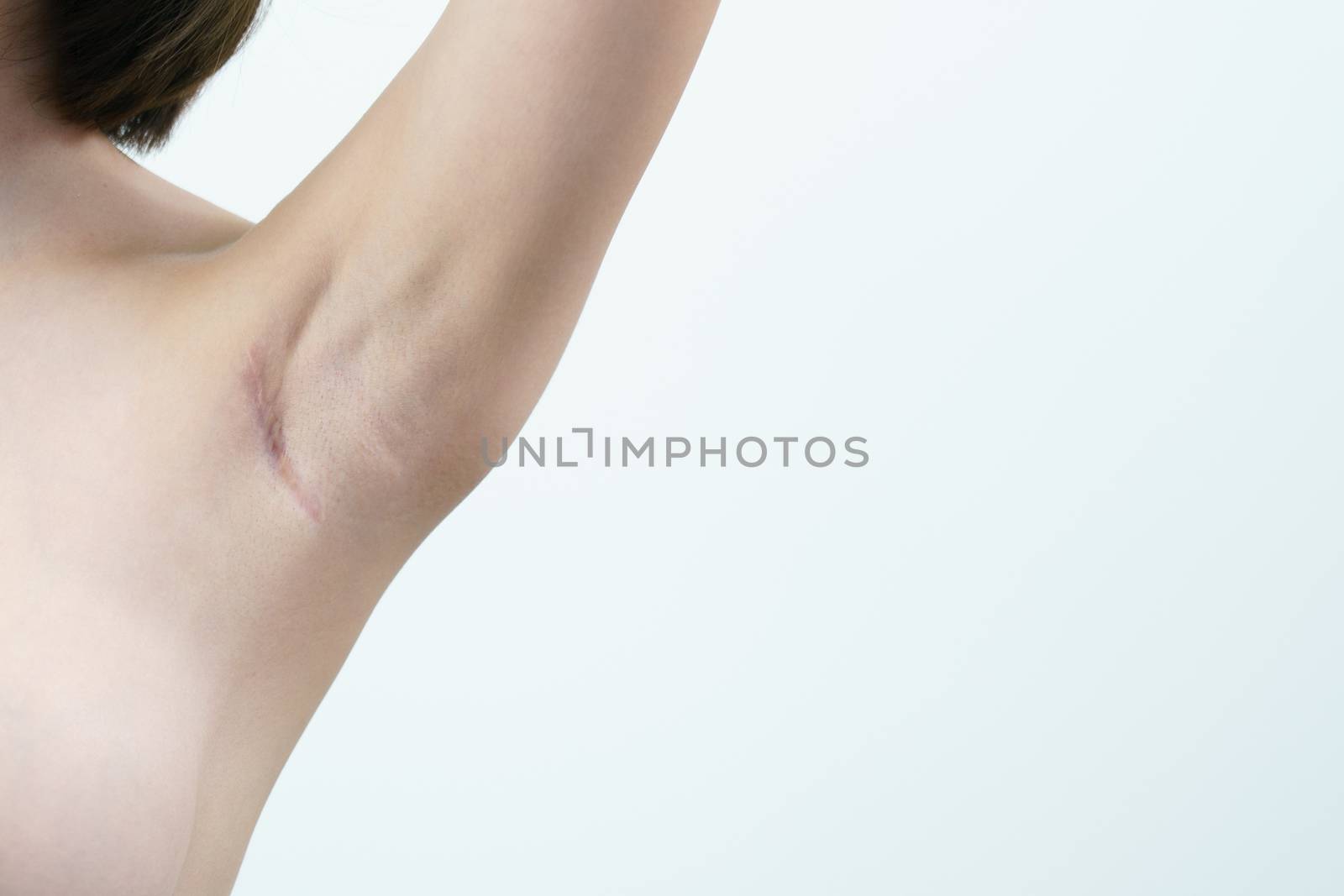 Woman showing keloids or scar on the armpit after breast surgery with caliper, breast implant surgery concept.