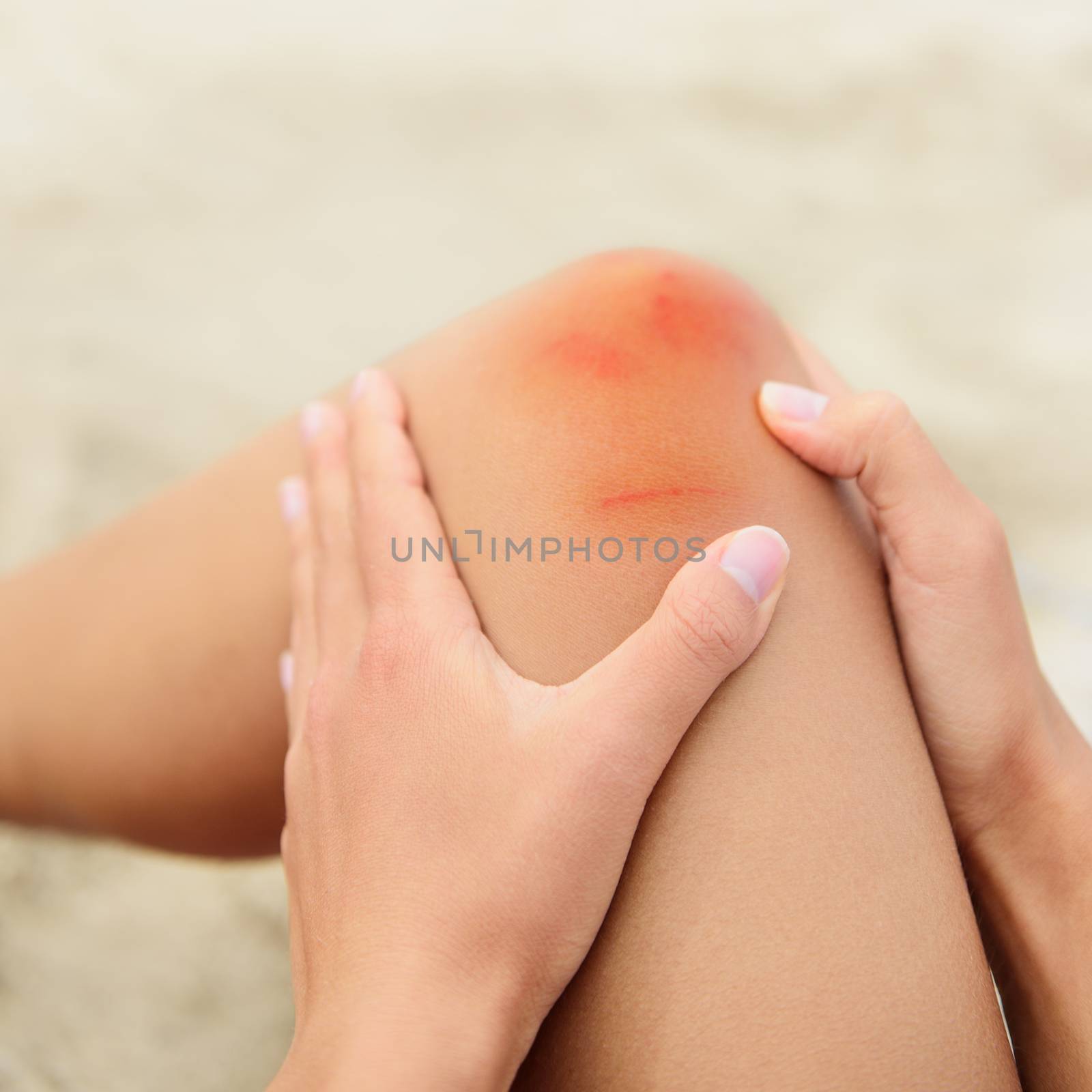 Woman nursing a bruised grazed knee by Maridav