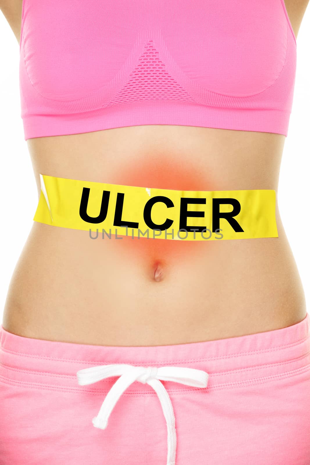 Ulcer. Conceptual Bare Woman Stomach with Yellow Tape, Emphasizing Ulcer Text, on White Background.