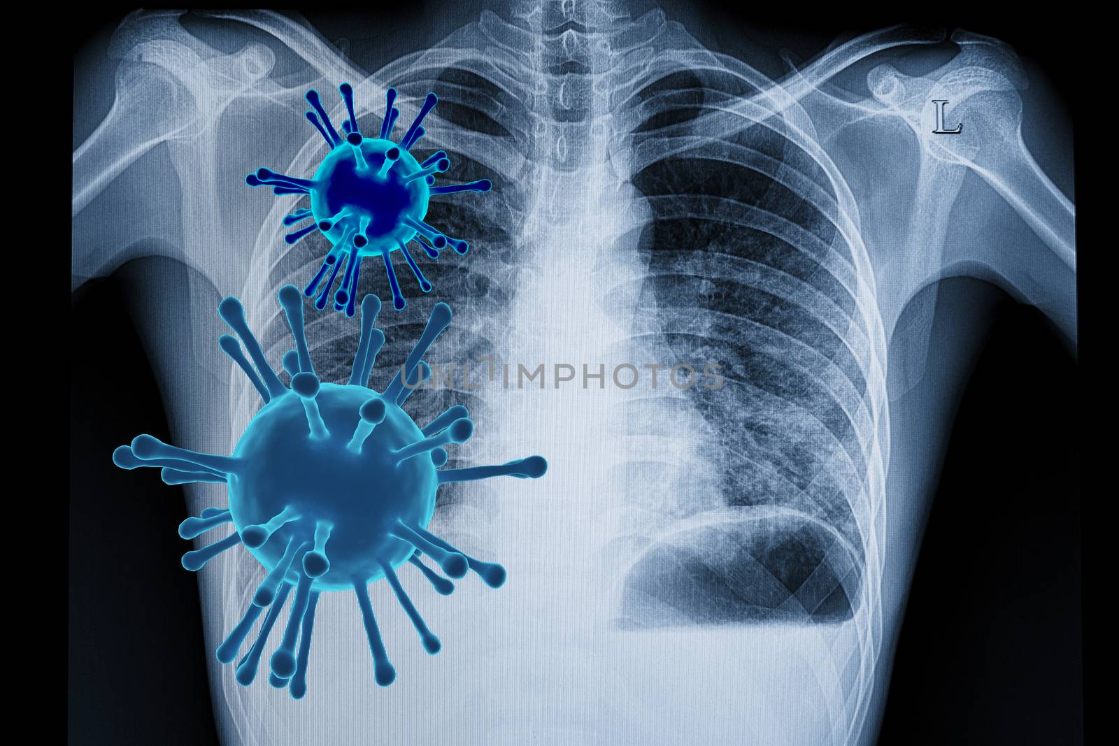Visual illustration of coronavirus (covid-19) infection in the lungs with 3D rendered viral particles and a chest xray film of a patient with bilateral lower lungs pneumonia.