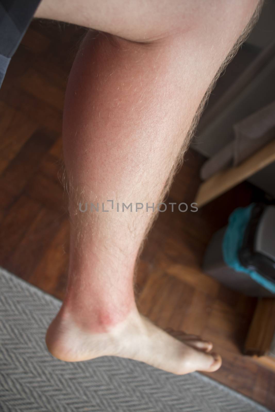 Red burned leg from the sun. Cape Town.