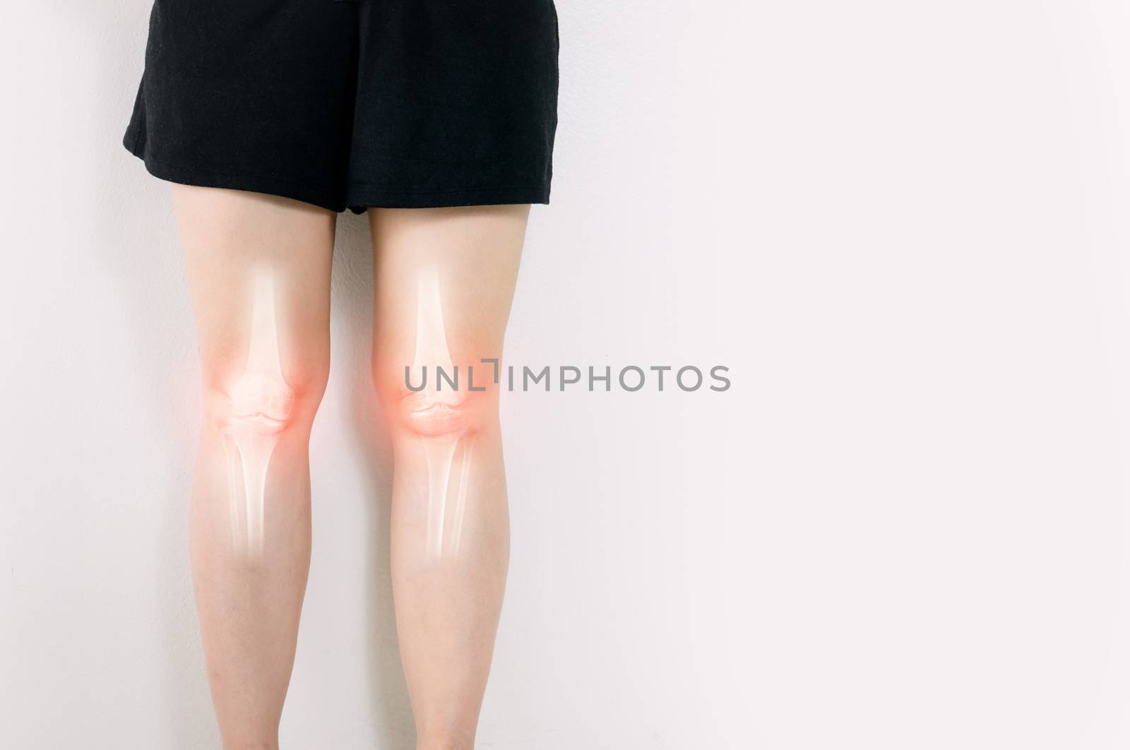 Human leg Osteoarthritis inflammation of bone joints  by sompongtom