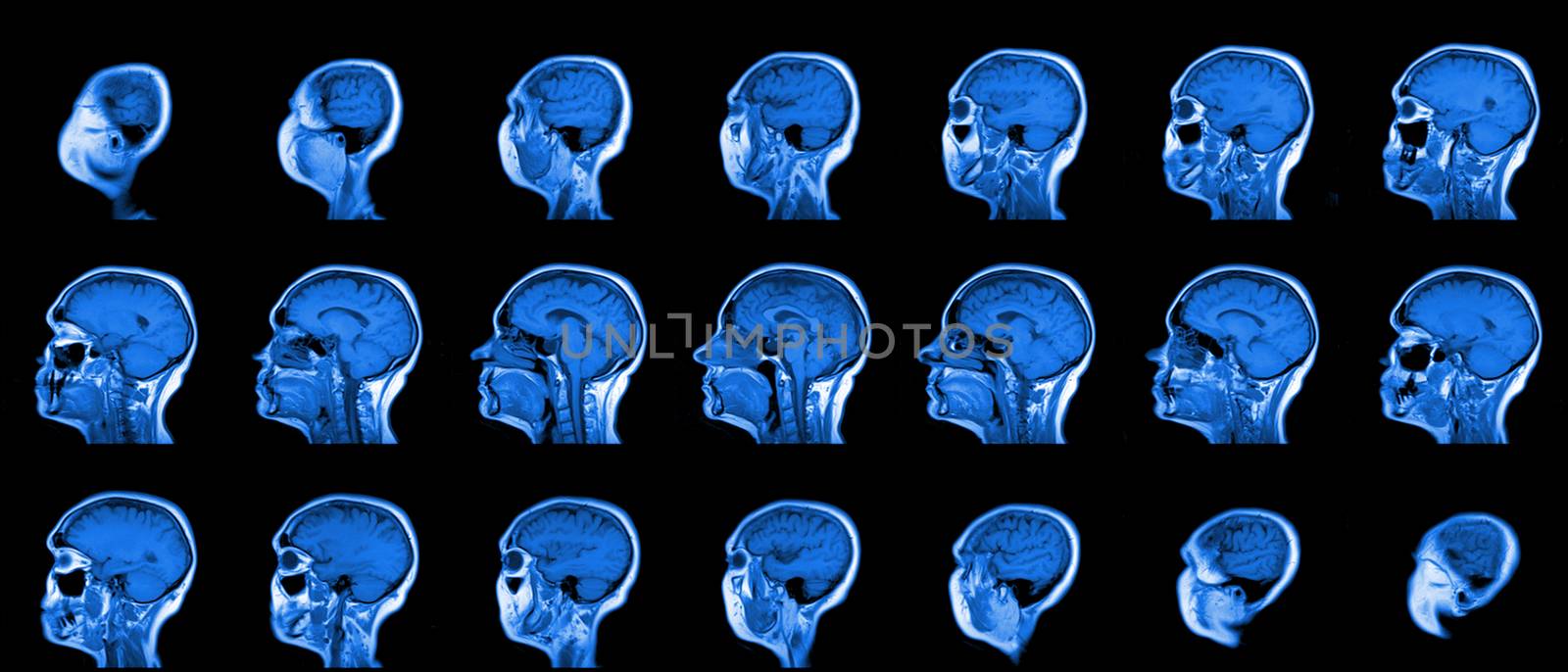 set of serial MRI scans of sixty years old caucasian female head in sagittal or longitudinal plane by z1b