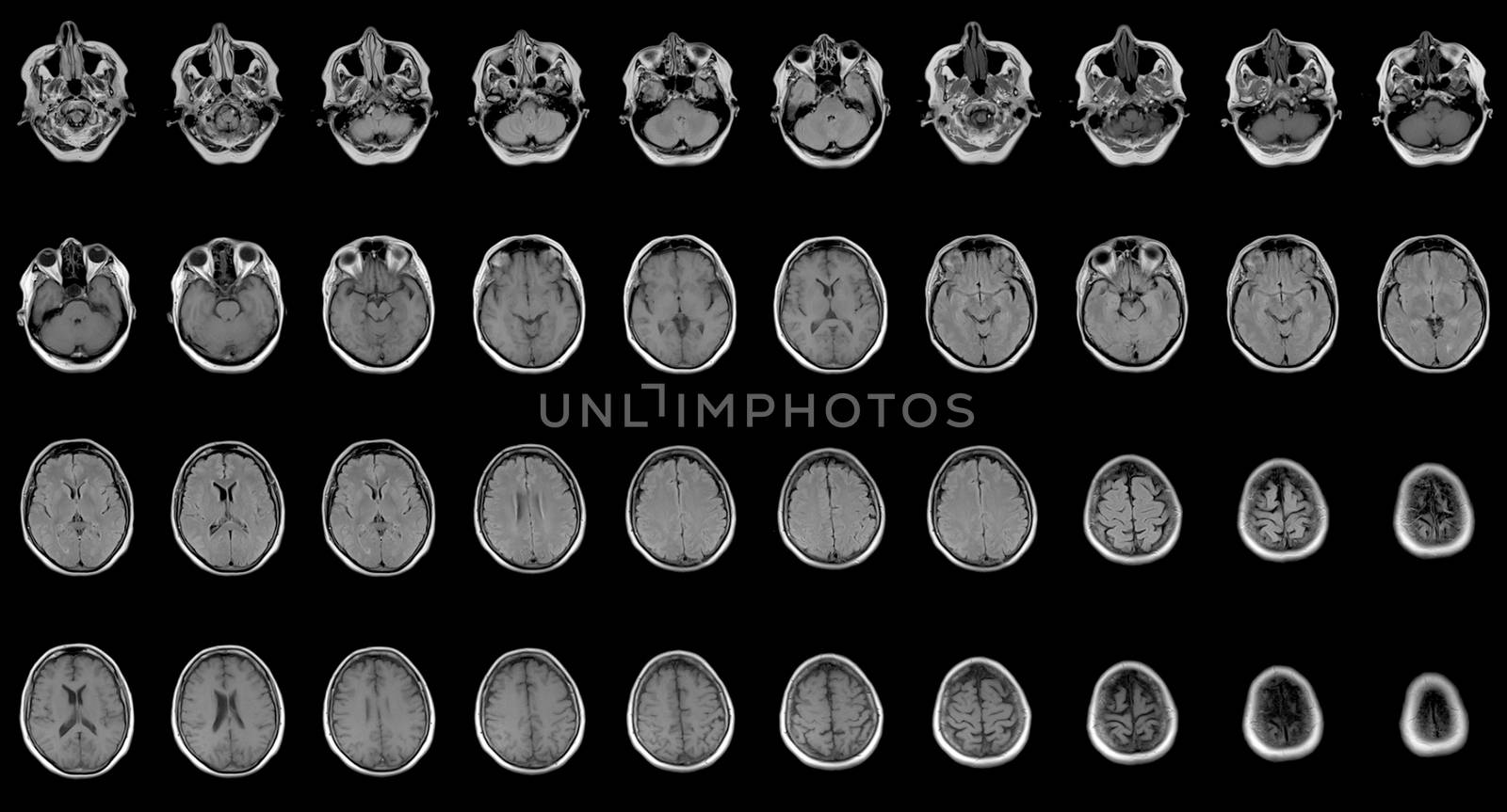 set of sequential MRI scans of sixty years old caucasian female head in two projections