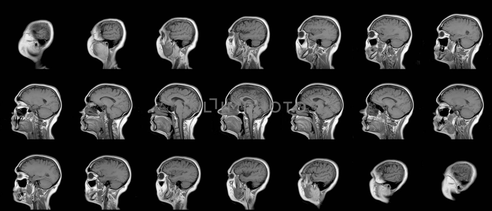 set of serial MRI scans of sixty years old caucasian female head in sagittal or longitudinal plane by z1b