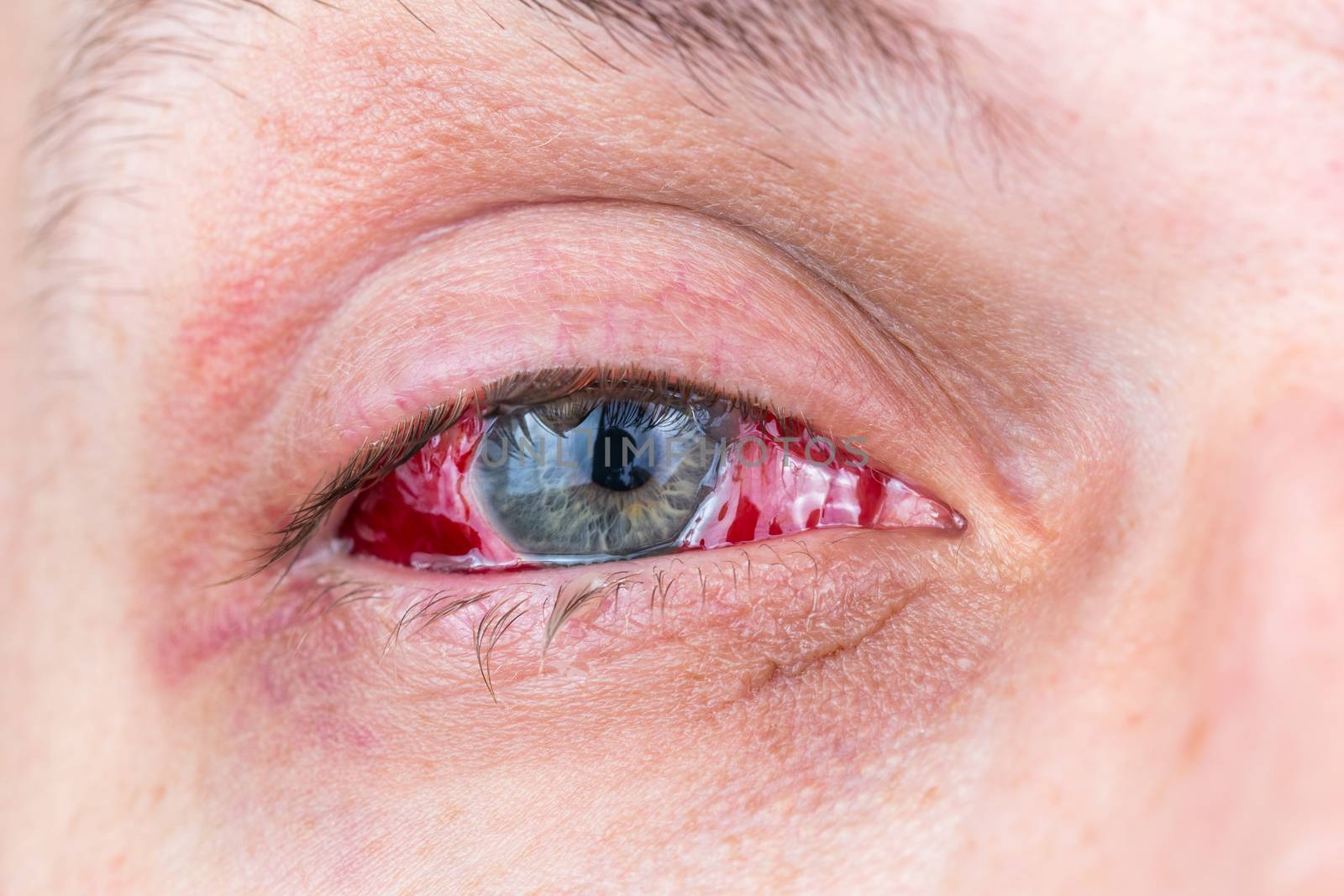 postoperative heavy inflamed eye close-up shot with selective focus and blur