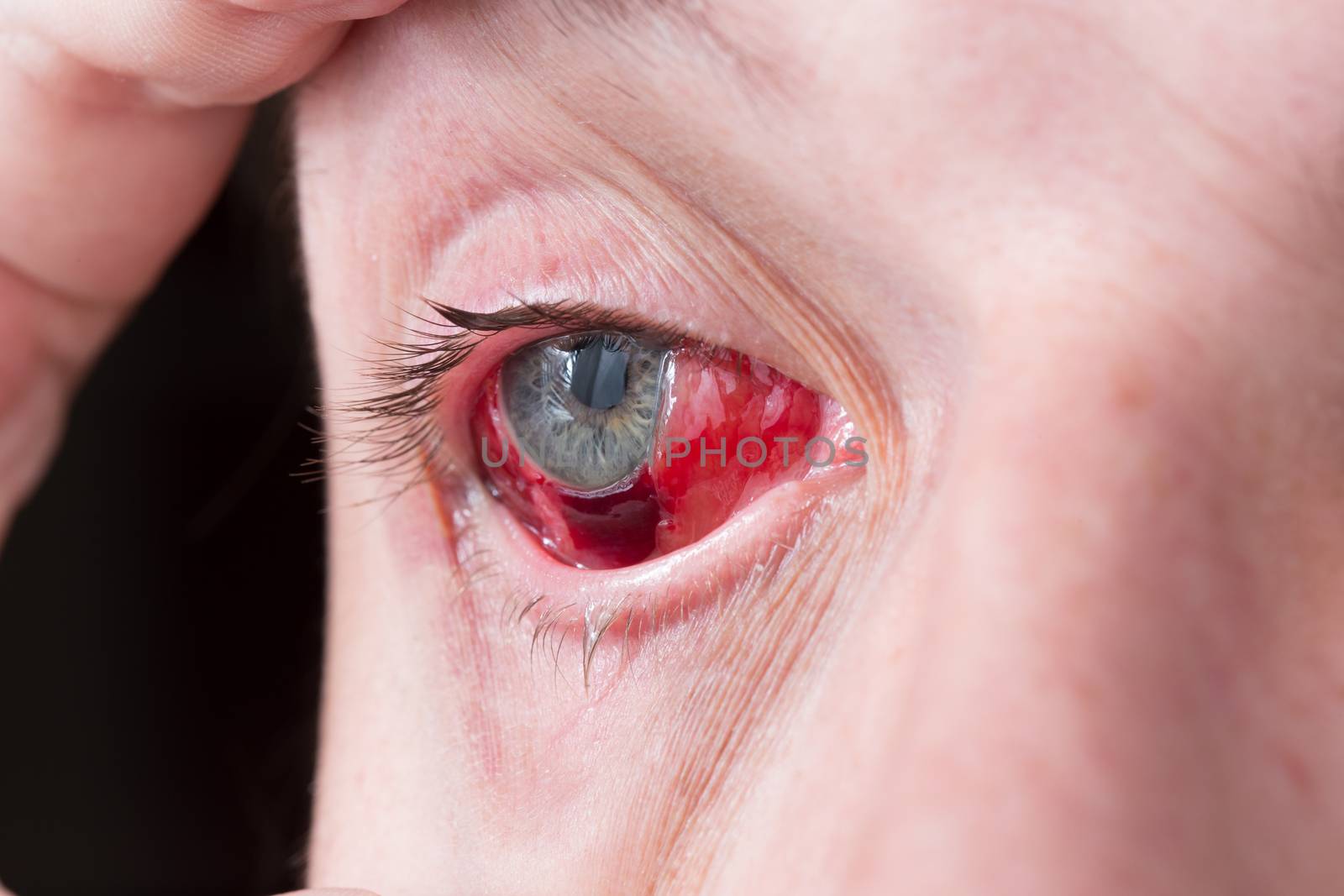 postoperative heavy inflamed eye closeup shot with selective focus and blur