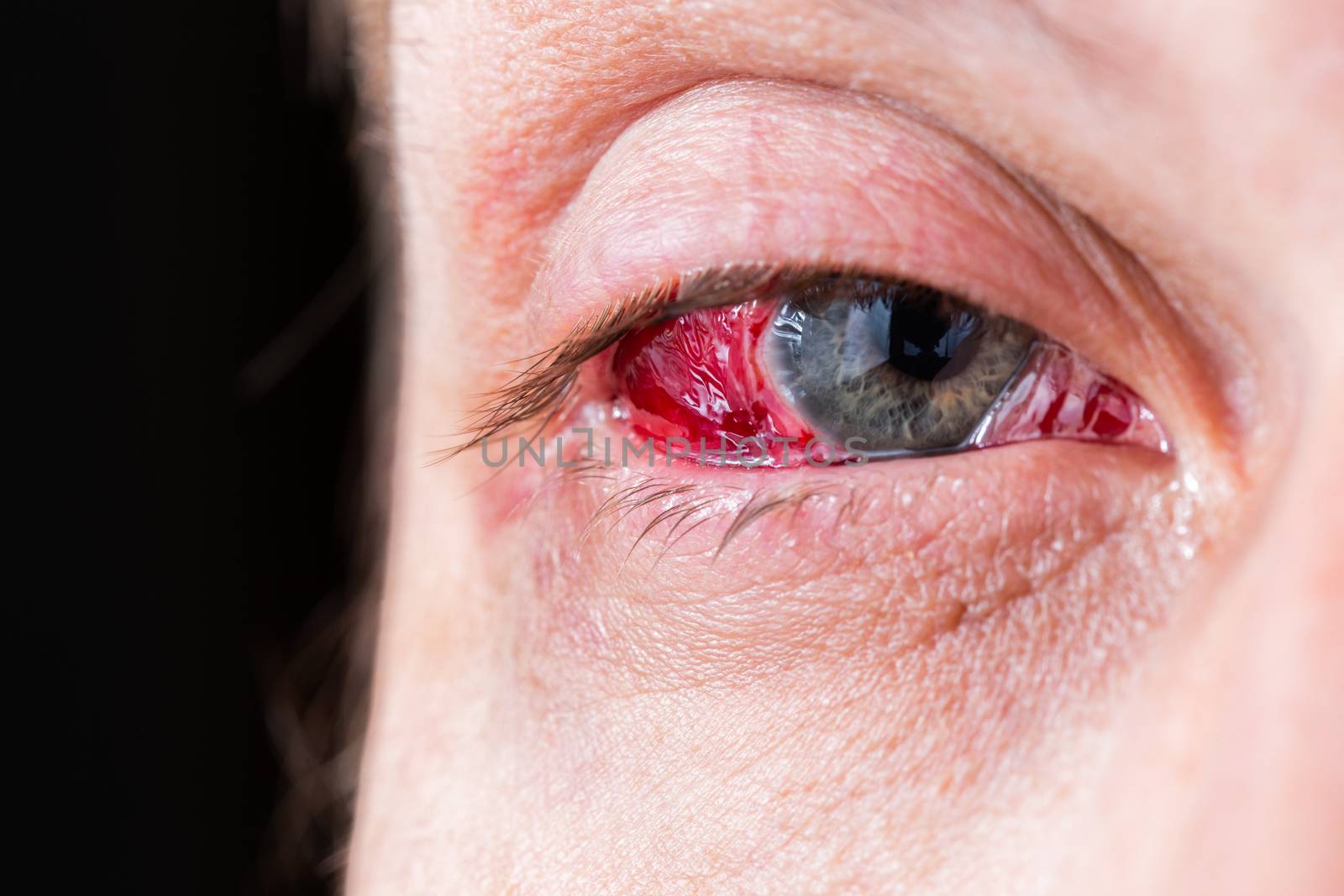 postoperative heavy inflamed eye closeup shot with selective focus and blur