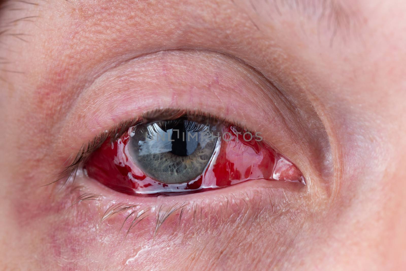 postoperative heavy inflamed eye closeup shot with selective focus and blur