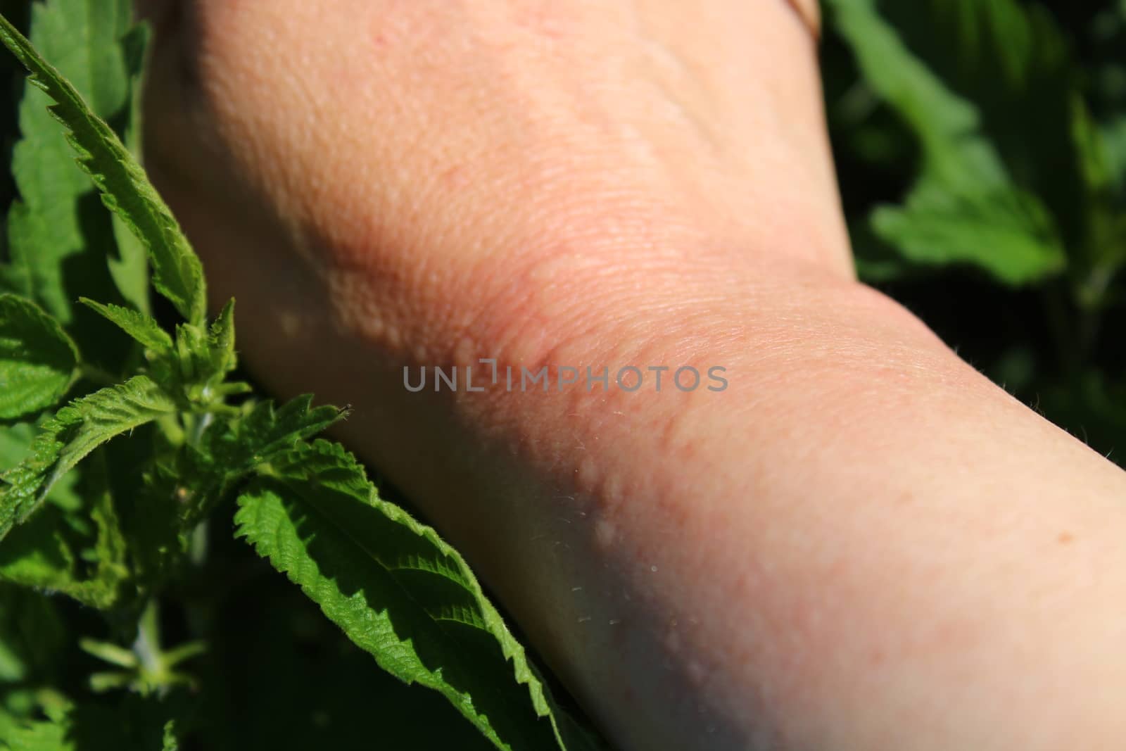 stinging nettles and an arm with nettle stings by martina_unbehauen