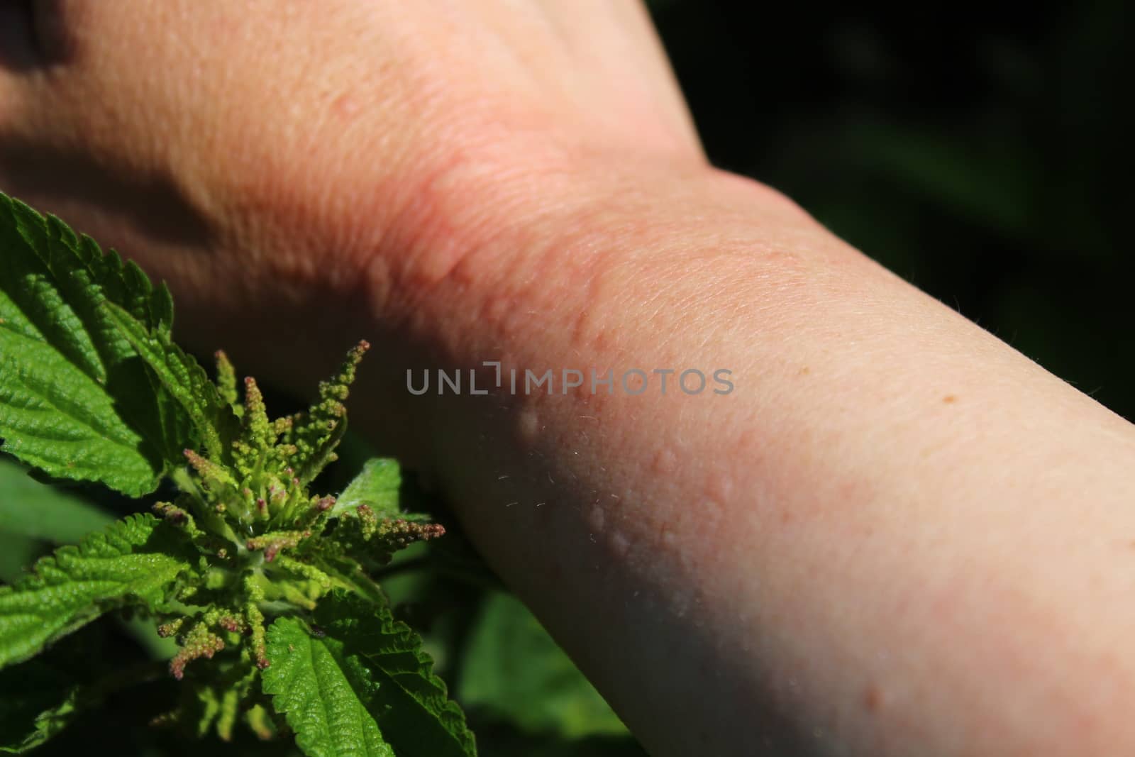 The picture shows stinging nettles and an arm with nettle stings