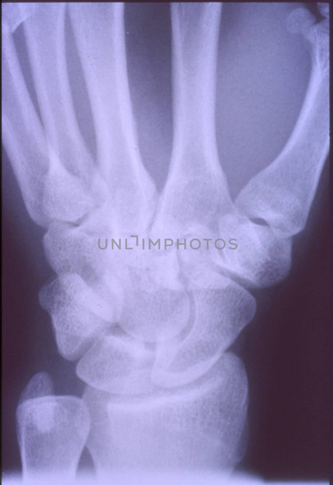 X-ray image, man, hand with bones and joints