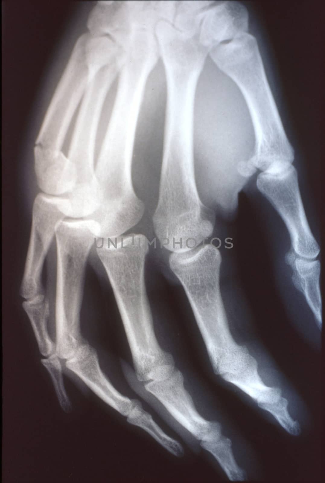 X-ray image, man, hand with bones and joints