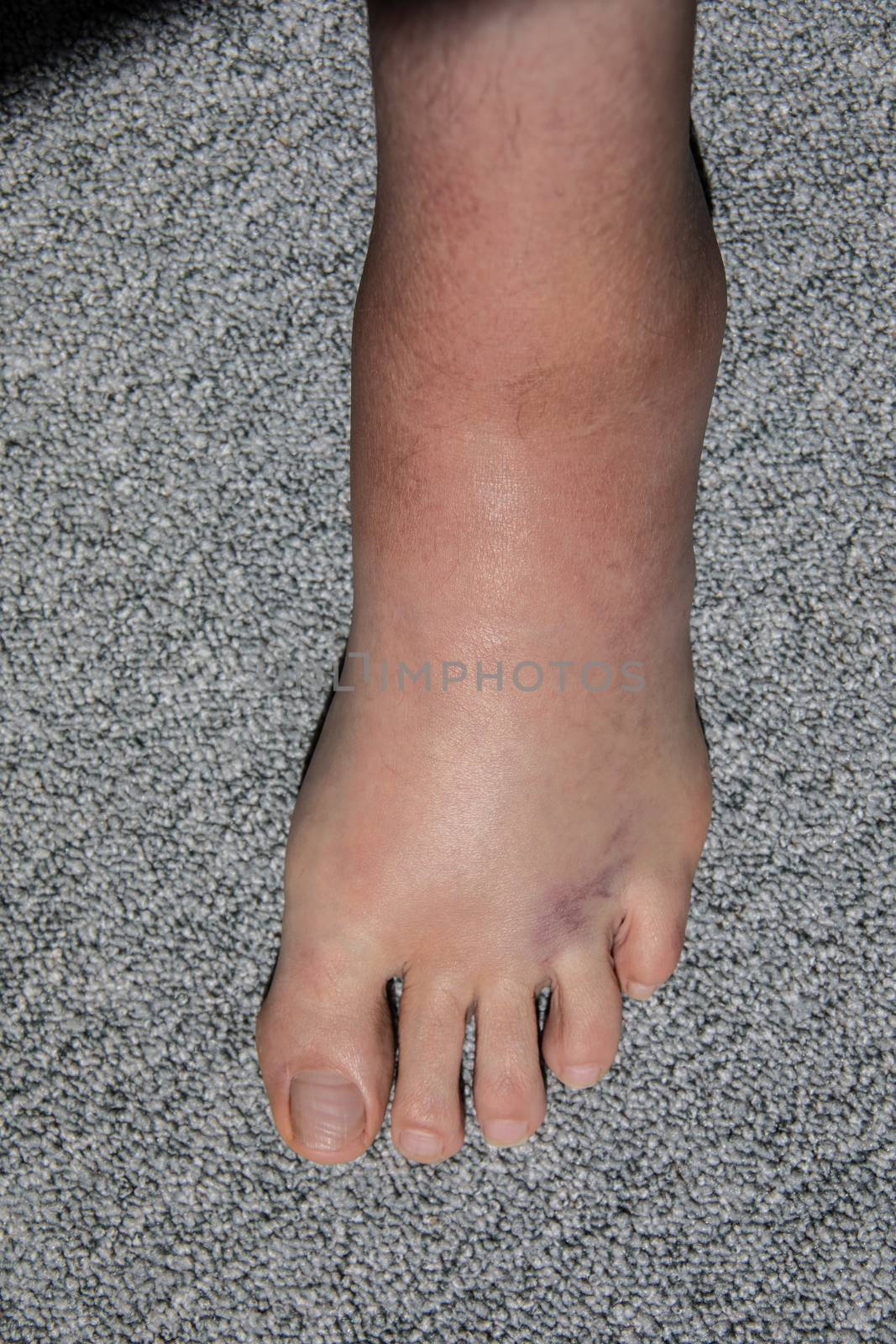 severe swelling and hematoma of the left foot after bending and ligament stretching