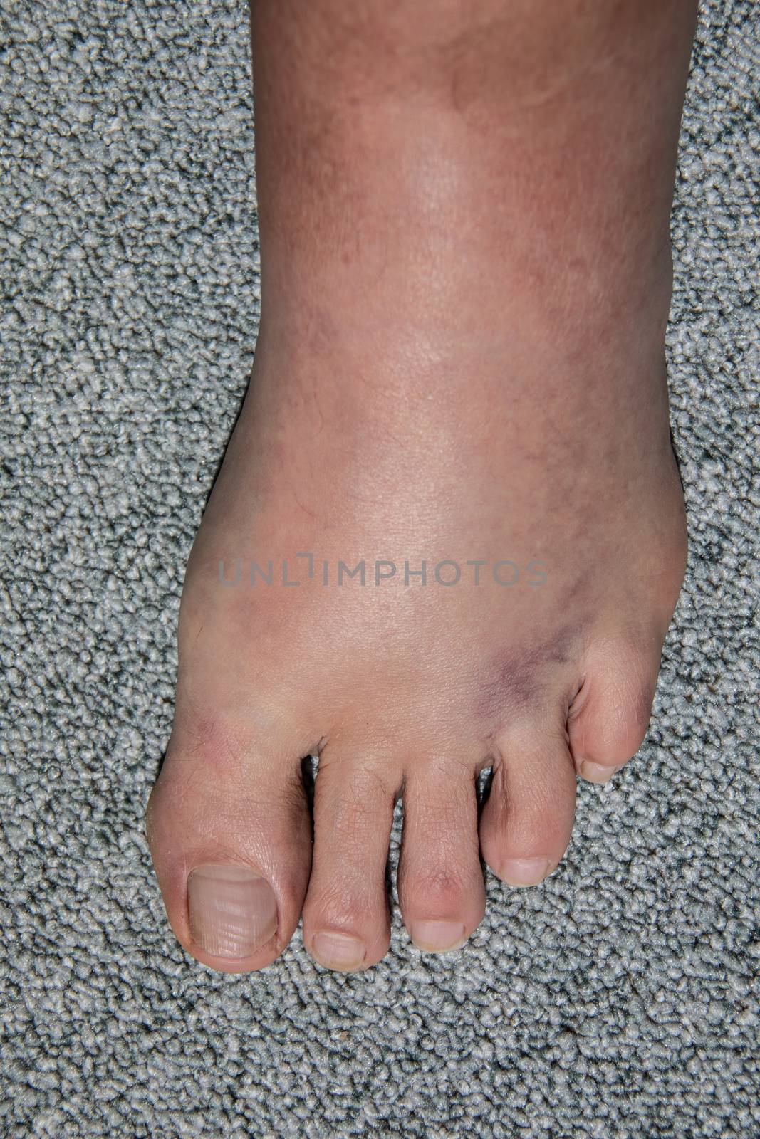 severe swelling and hematoma of the left foot after bending and ligament stretching