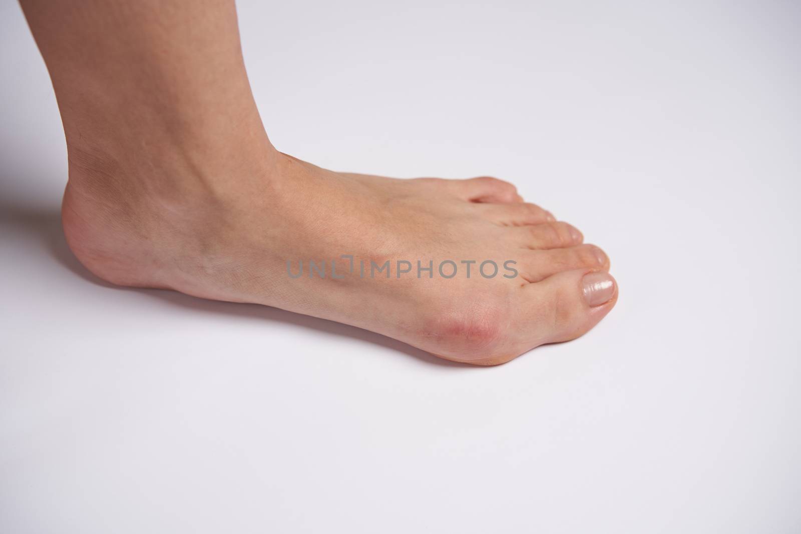 Hllux Valgus on female legs close up isolated on white background. Foot joint deformity. Health care and medicine problem with human body