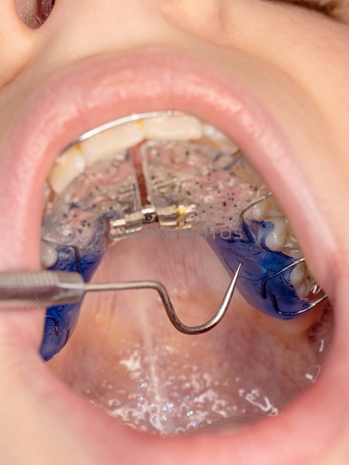 Dentist checking bracket at the braces of kid by rdonar2