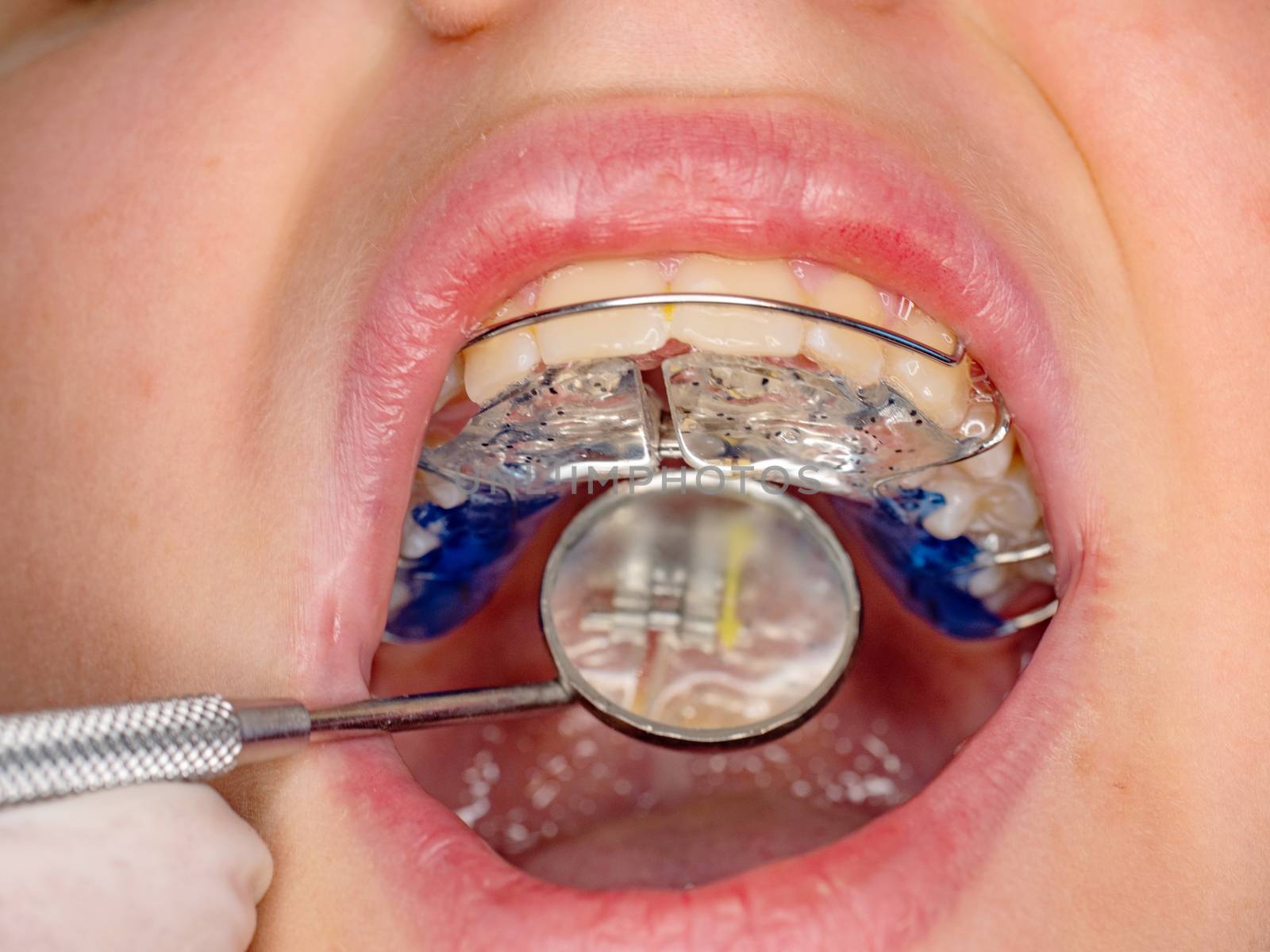 Control of teeth braces setting in patient mouth. by rdonar2