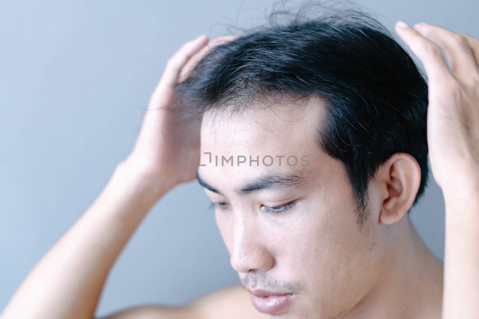 Young man serious hair loss problem for health care medical and  by pt.pongsak@gmail.com