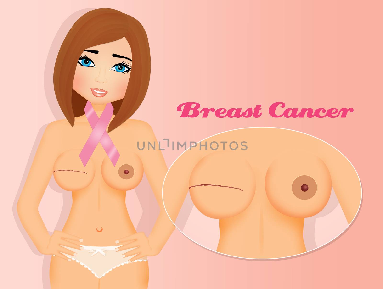 Breast Cancer by adrenalina
