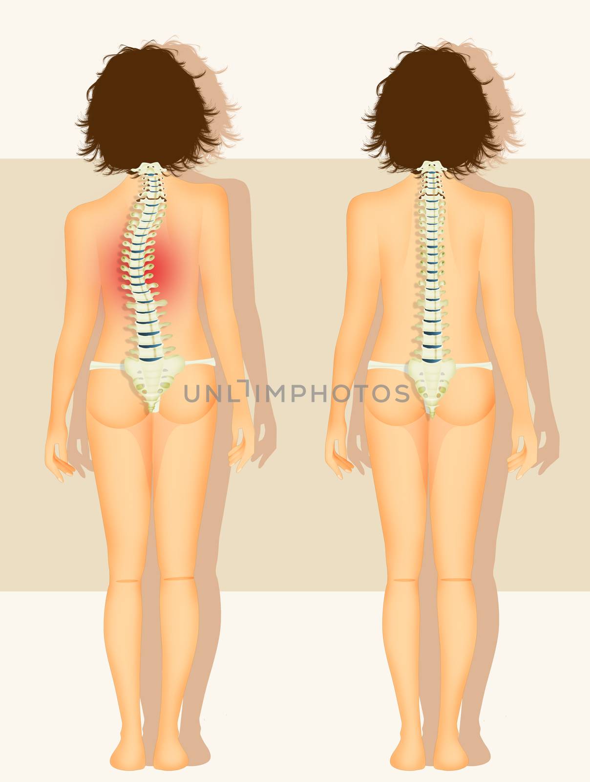 woman with scoliosis problem by adrenalina