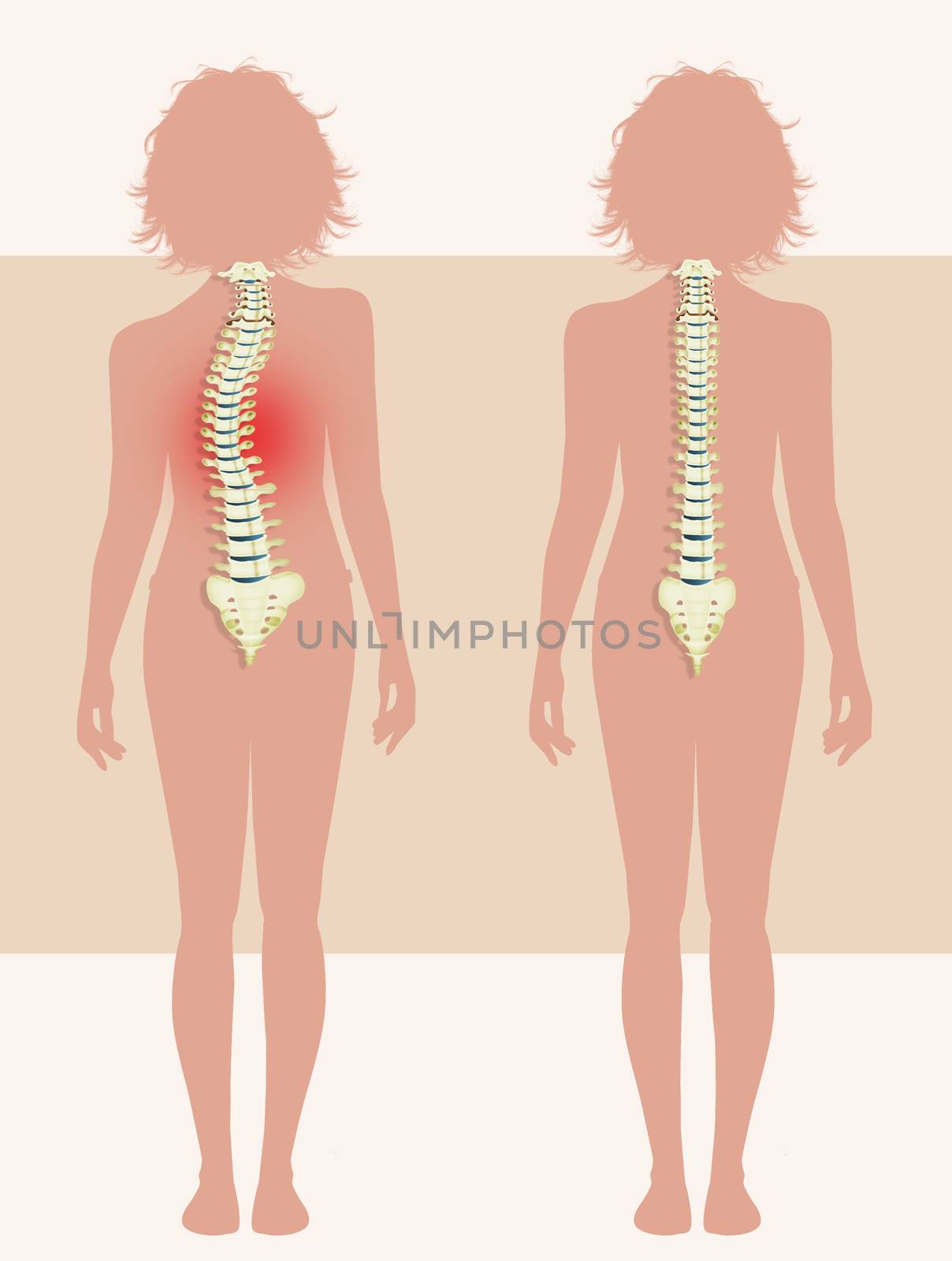 illustration of girl with scoliosis problem
