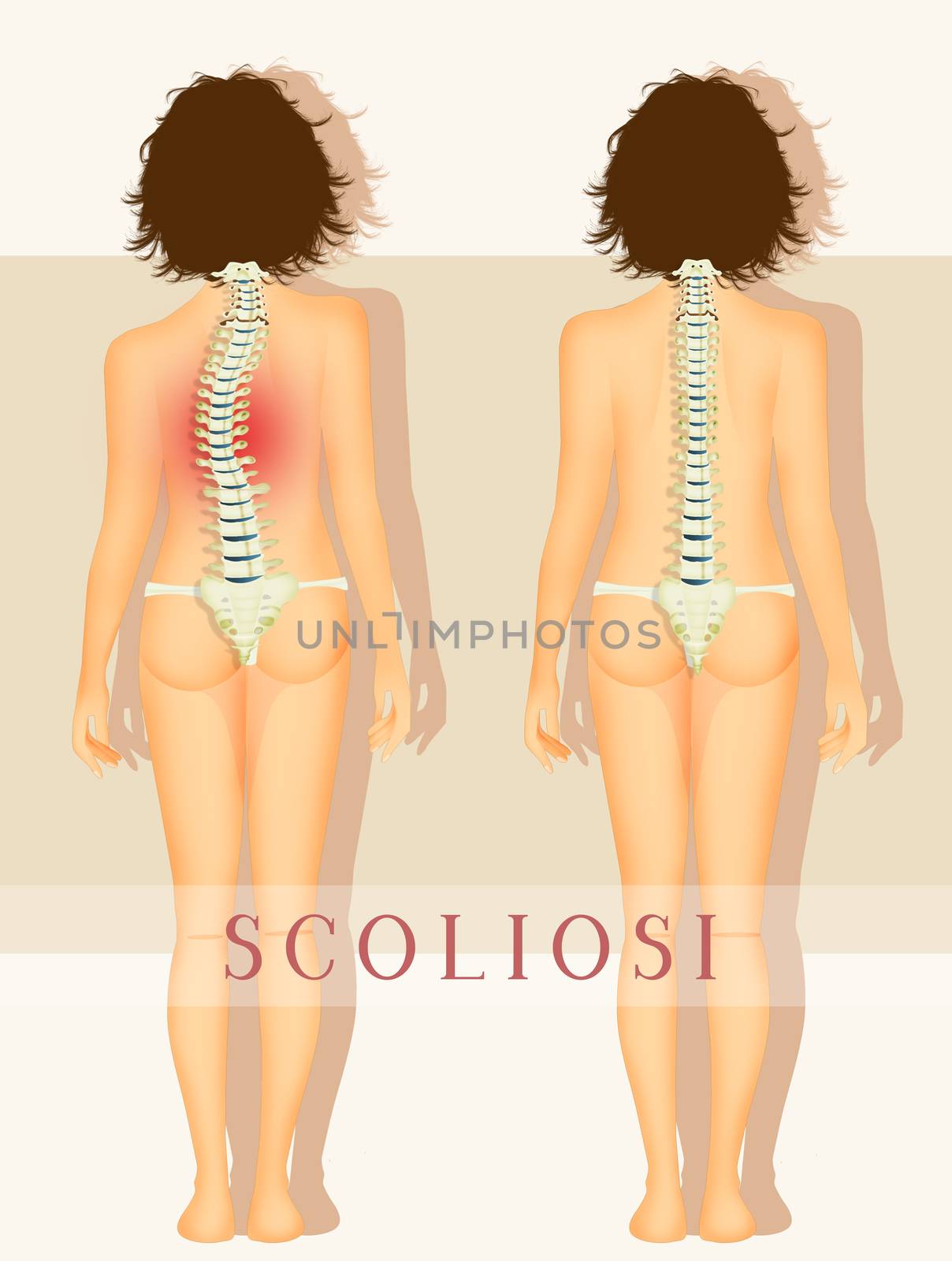 illustration of scoliosis by adrenalina