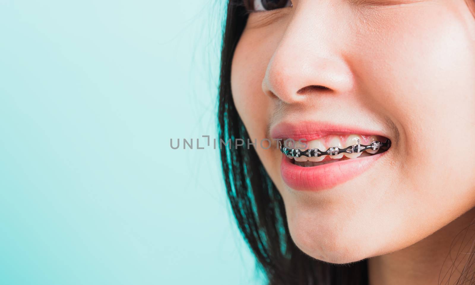 Wman smile have dental braces on teeth laughing by Sorapop