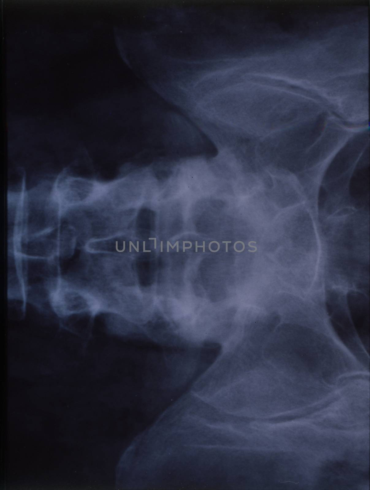 X-ray image of the spine for medical diagnosis