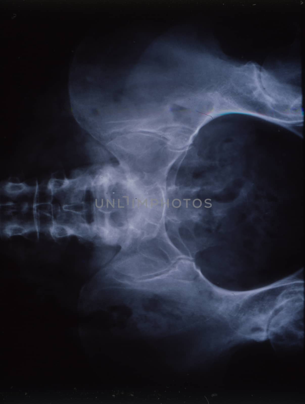 X-ray image of a woman with a pelvis and spine by Dr-Lange