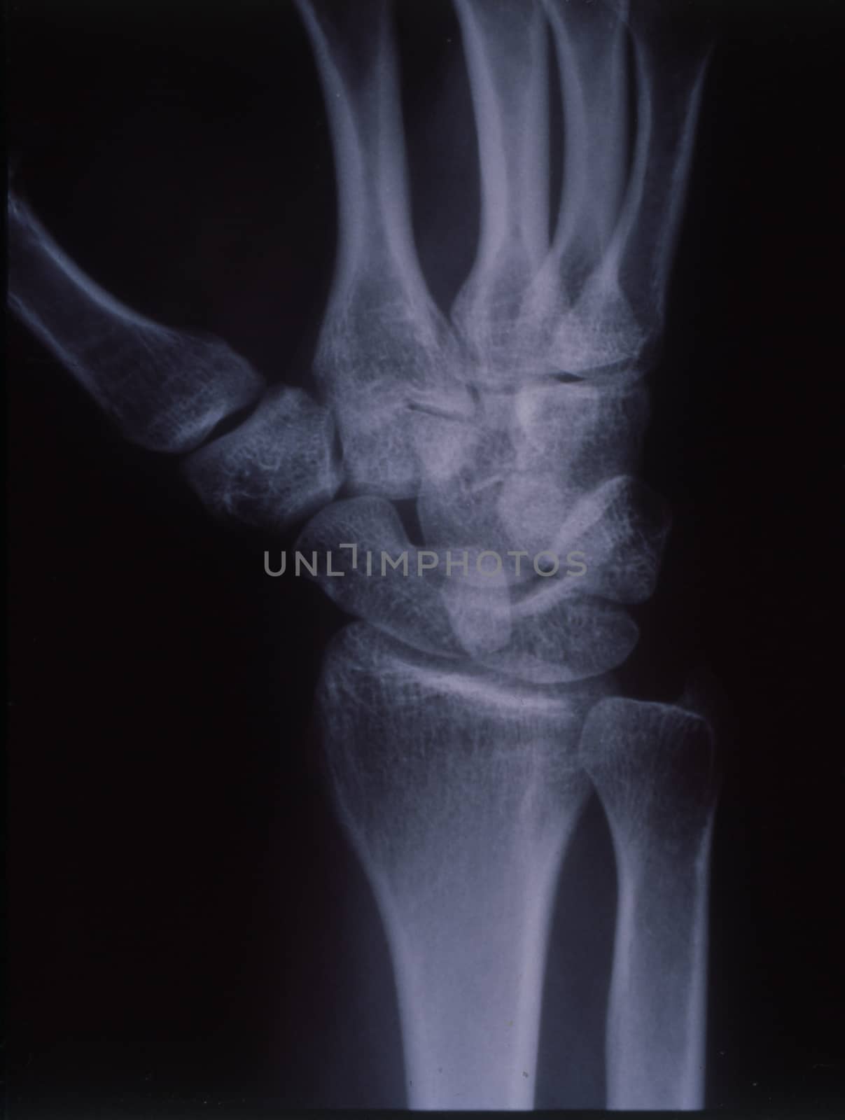 X-ray image, man, hand with bones and joints