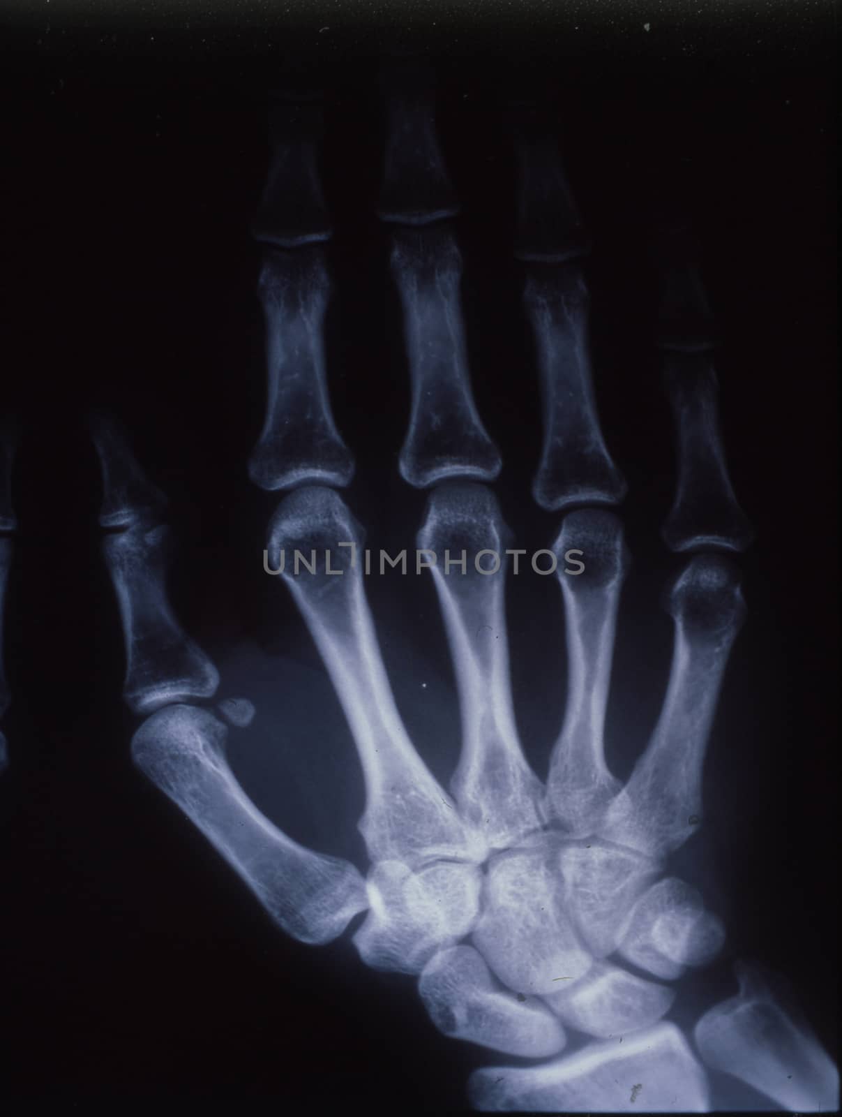 X-ray image, man, hand with bones and joints by Dr-Lange