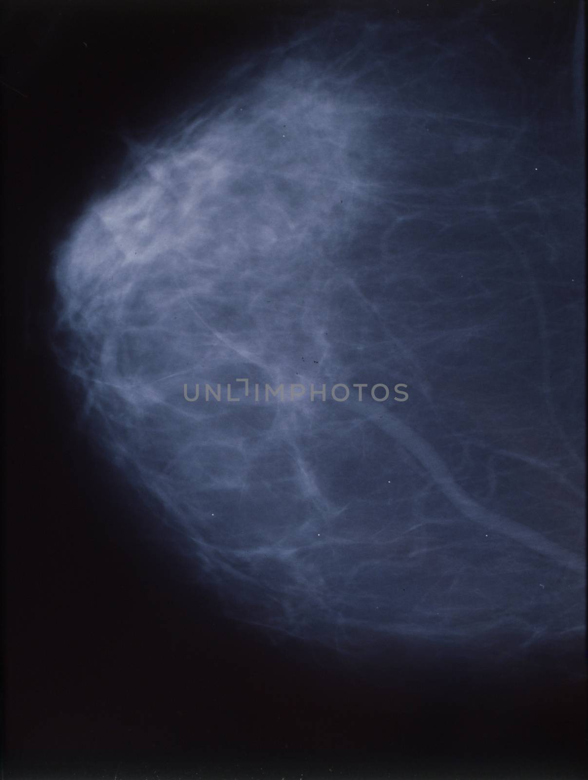 X-ray as mammography of the female breast