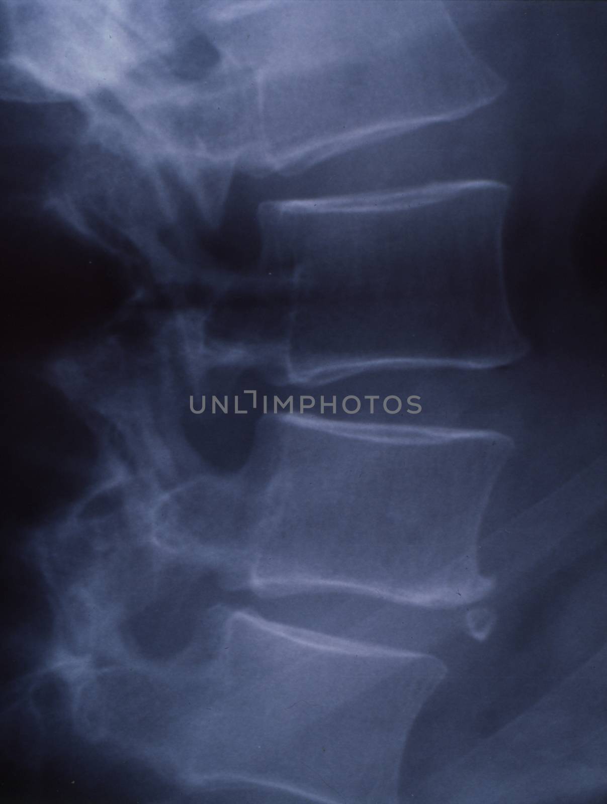 X-ray image of the spine for medical diagnosis